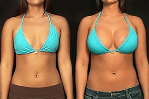 breast-augmentation-before-after-sidebar.png